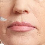 Neurotoxin: A Non-Invasive Alternative to Traditional Wrinkle Treatments