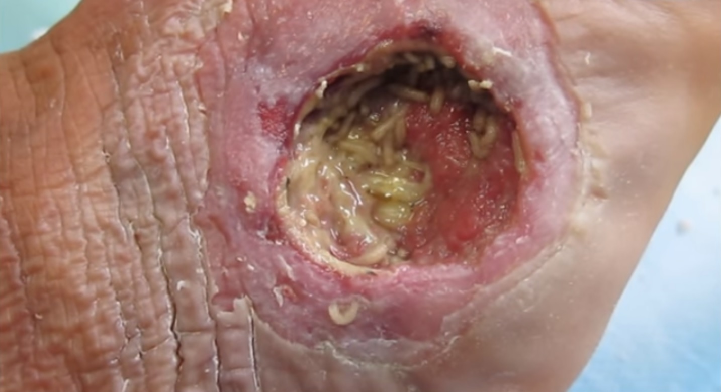 4 Aspects of Diabetic Wound Care
