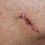 Benefits of a Mohs Surgery