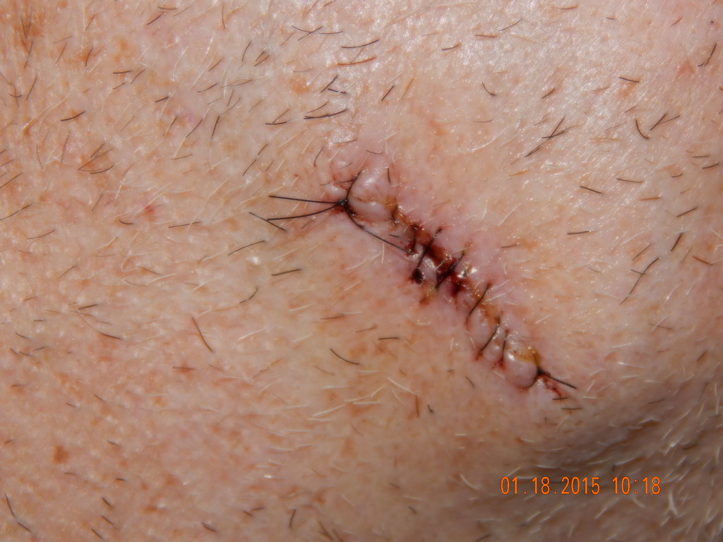 Benefits of a Mohs Surgery