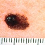 Early Signs of Skin Cancer