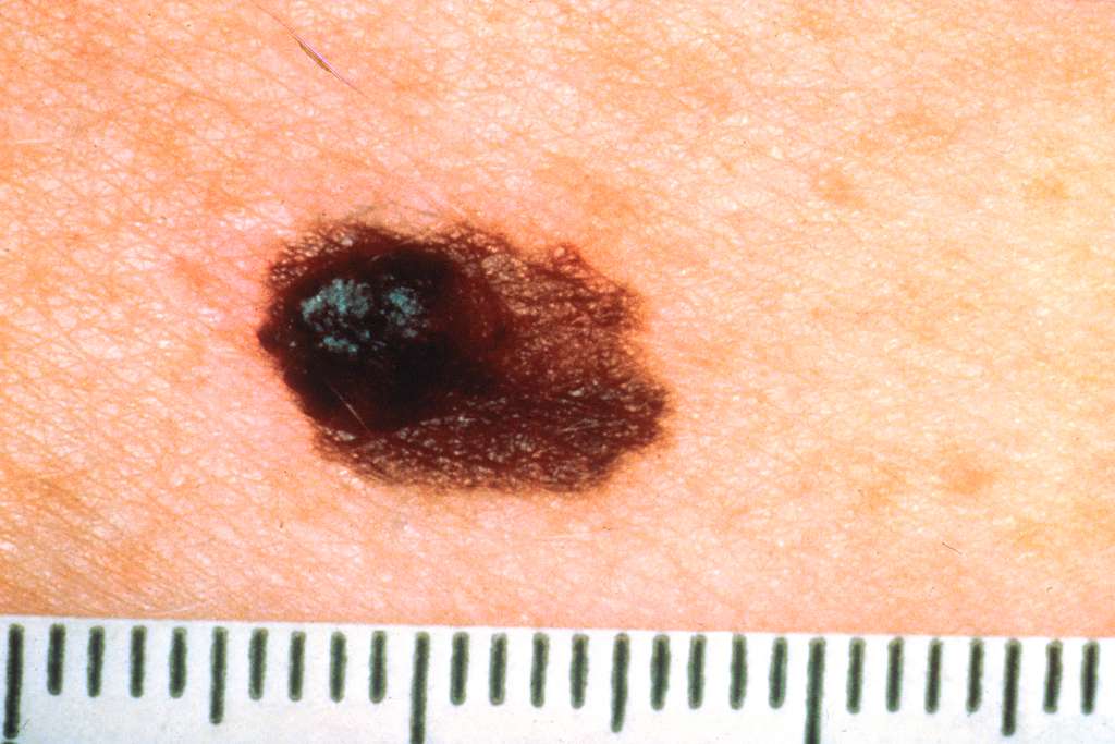 Early Signs of Skin Cancer