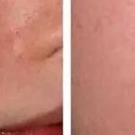 The Role of Scar Revision for Improved Skin Texture