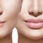4 Types of Dermal Fillers