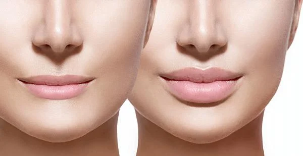 4 Types of Dermal Fillers