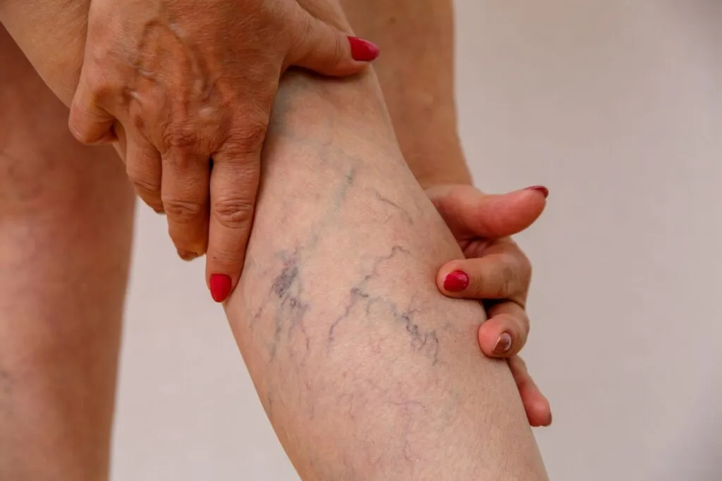 Home Remedies and Treatments for Varicose Veins