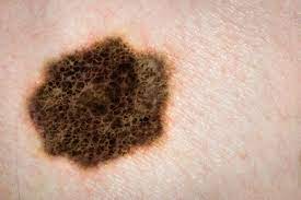 How Dermatology Is Evolving to Treat Skin Cancer
