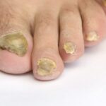 How Foot Fungus Affects Your Skin and Nails