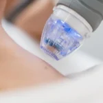How Morpheus-8 Combines Microneedling and Radiofrequency for Skin Tightening