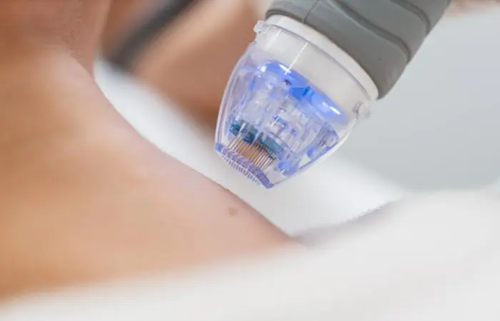 How Morpheus-8 Combines Microneedling and Radiofrequency for Skin Tightening