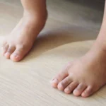 How To Know When a Bunion Requires Surgery