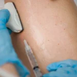 How Varicose Veins Can Affect Your Circulatory System