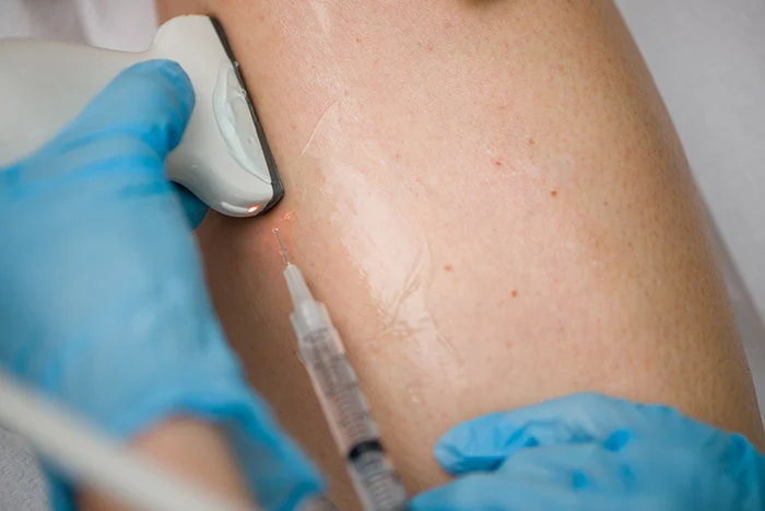 How Varicose Veins Can Affect Your Circulatory System