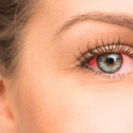 How to Know When Red Eyes Require Medical Attention
