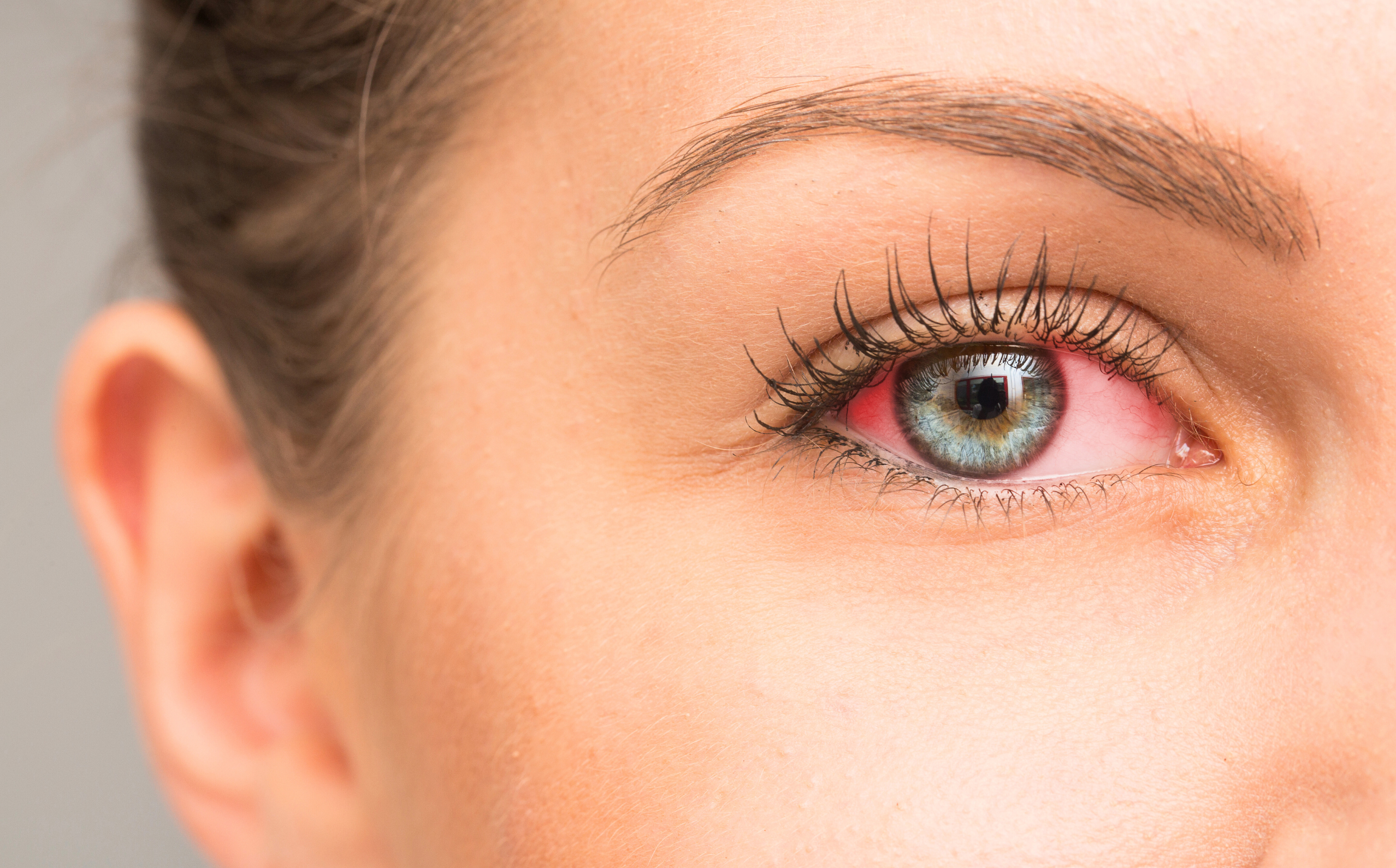 How to Know When Red Eyes Require Medical Attention