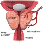 Innovative Research and Advancements in Prostate Cancer Treatment