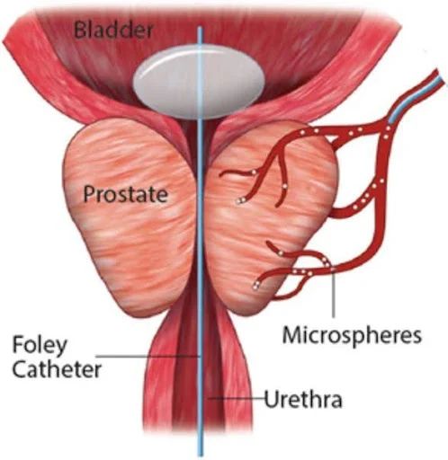 Innovative Research and Advancements in Prostate Cancer Treatment