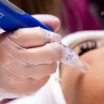 The Connection Between Microneedling and Collagen Production