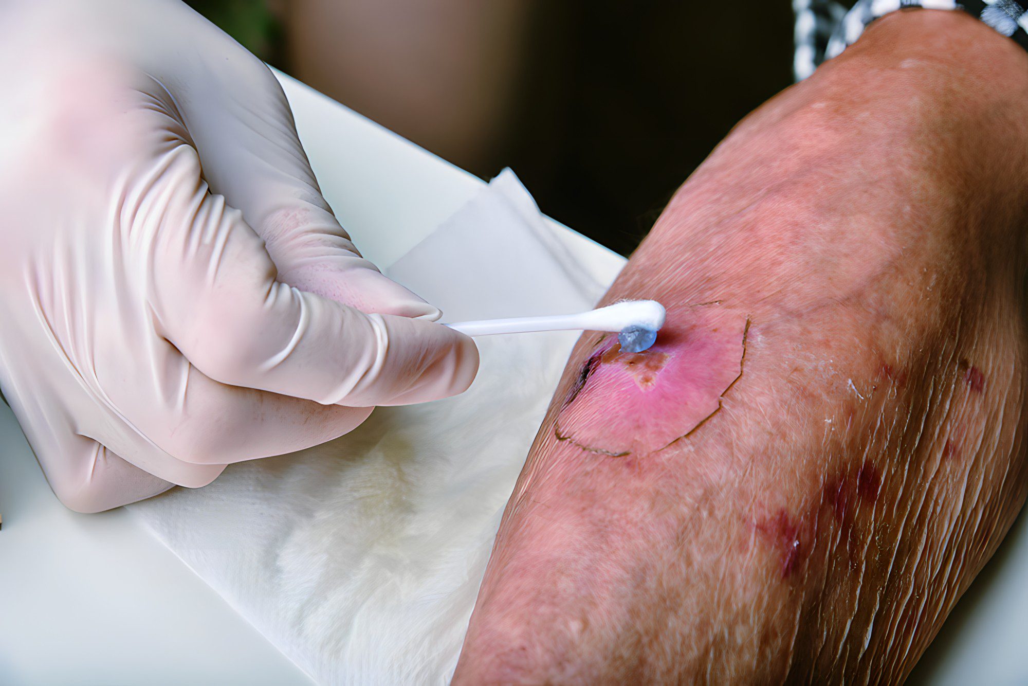 The Role of Moisture in Effective Wound Care