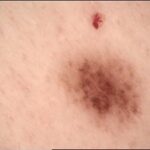 Understanding Different Types of Skin Cancer