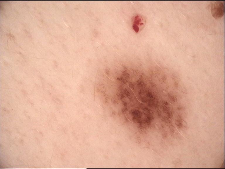 Understanding Different Types of Skin Cancer