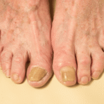Understanding the Impact of Fungal Nails on Quality of Life