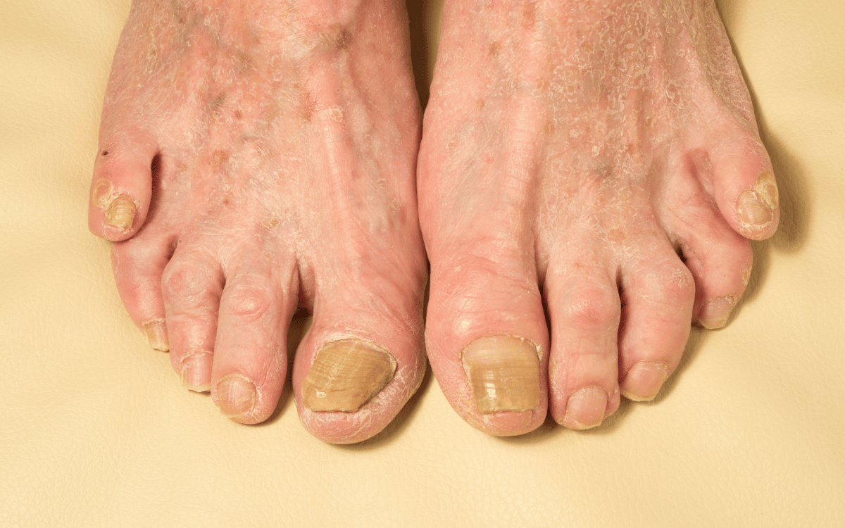 Understanding the Impact of Fungal Nails on Quality of Life