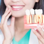 What Issues Require Tooth Replacement?