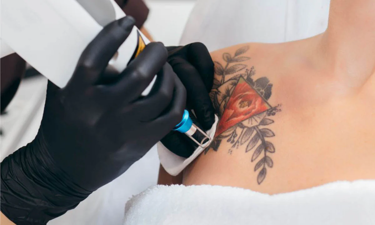 What To Expect During Tattoo Removal