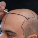 Benefits of Choosing a Hair Transplant