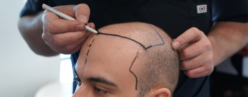 Benefits of Choosing a Hair Transplant