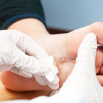 Home Remedies for Plantar Warts