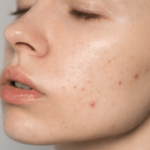 Determining Which Acne Treatment Is Right for You