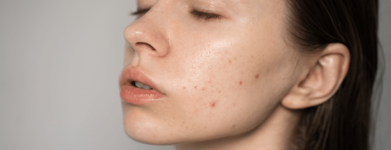 Determining Which Acne Treatment Is Right for You