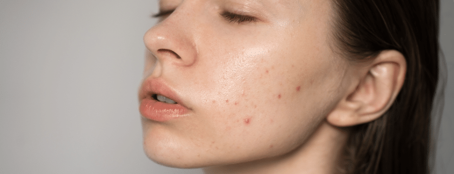Determining Which Acne Treatment Is Right for You