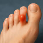 Understanding the Causes and Risk Factors of Neuroma