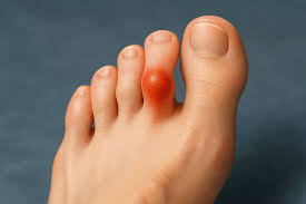 Understanding the Causes and Risk Factors of Neuroma