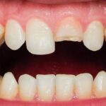Understanding the Causes and Treatment Options for Cracked Teeth