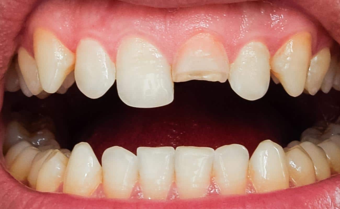 Understanding the Causes and Treatment Options for Cracked Teeth