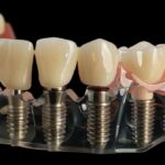 How Dental Implants Can Enhance Your Quality of Life