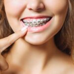 How Orthodontics Can Correct Misaligned Teeth