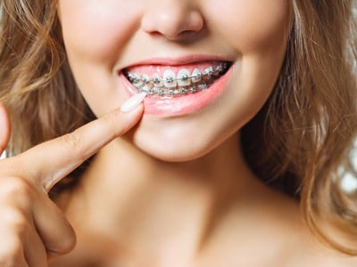 How Orthodontics Can Correct Misaligned Teeth